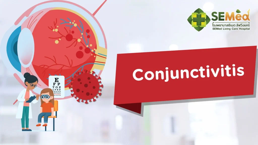 Conjunctivitis EN